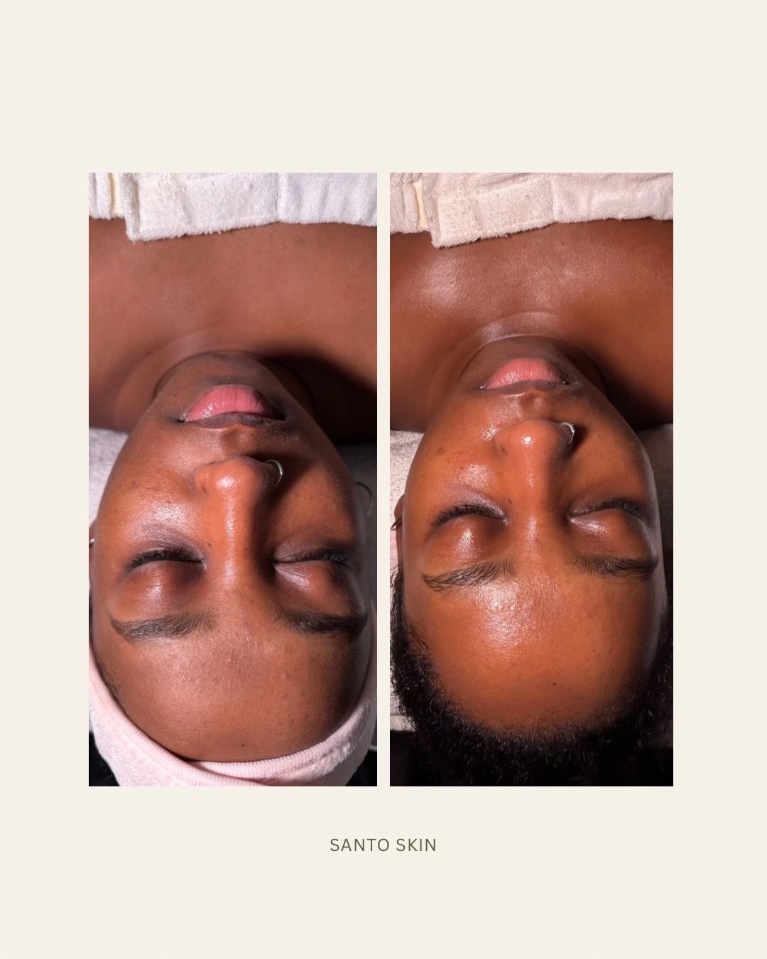 Second client before and after a facial, showing smoother, glowing skin